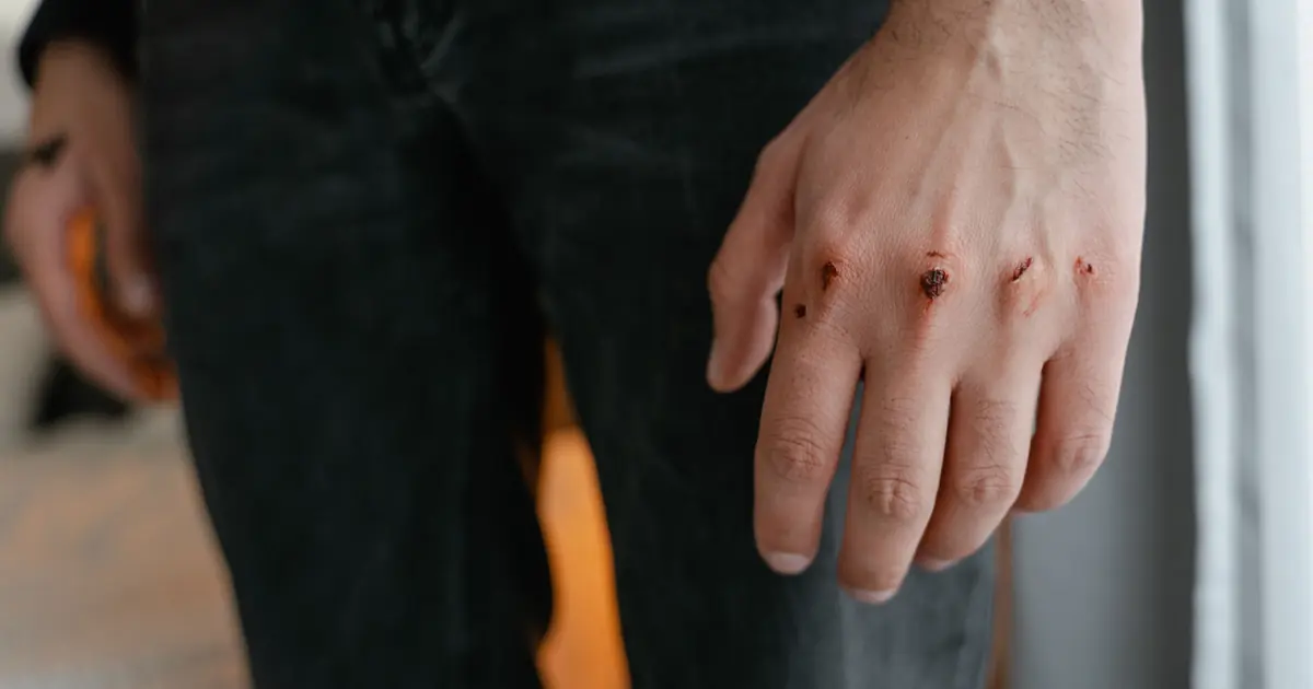 Red scratch mark on a human hand where cat scratch disease bacteria can enter